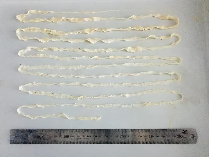 肉千万不能这样吃！有人因此贫血，颅内病变还可能诱发癫痫